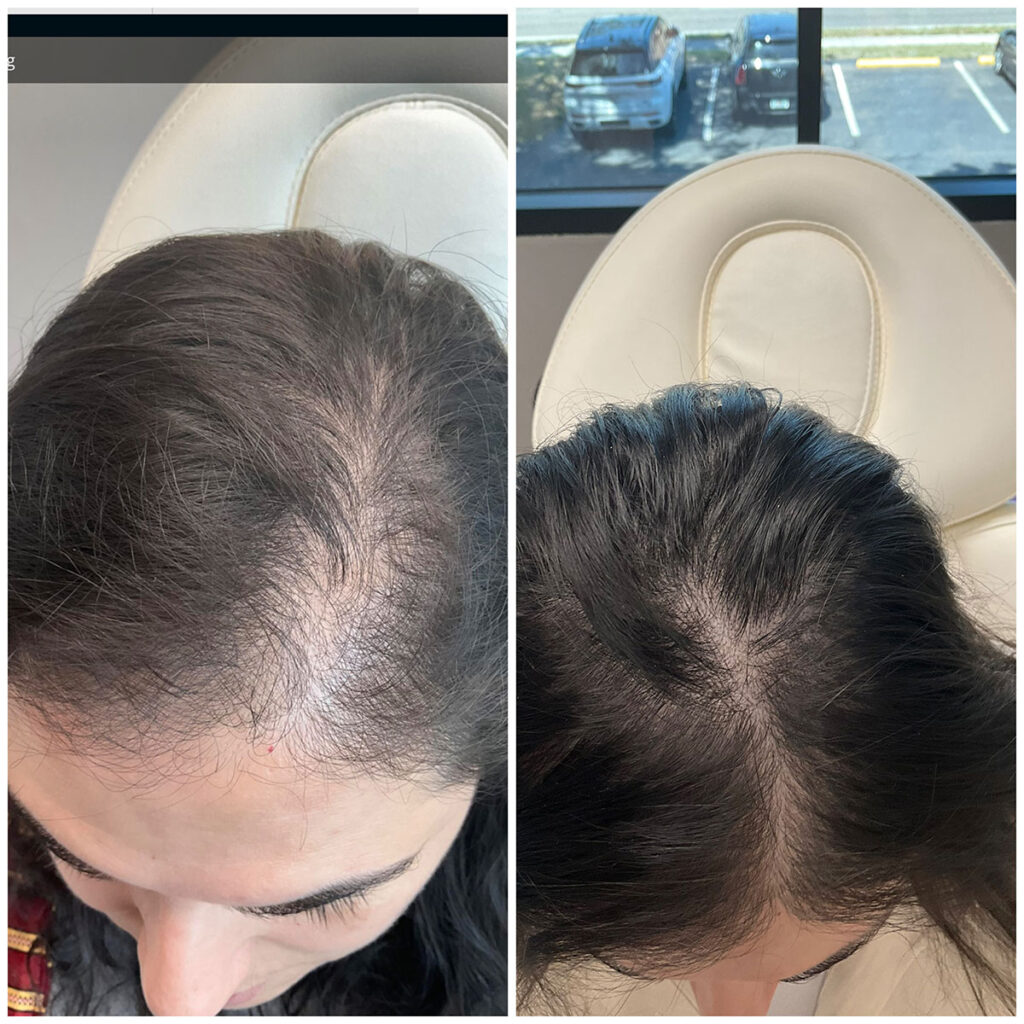 Regenicel Aesthetics Before & After
