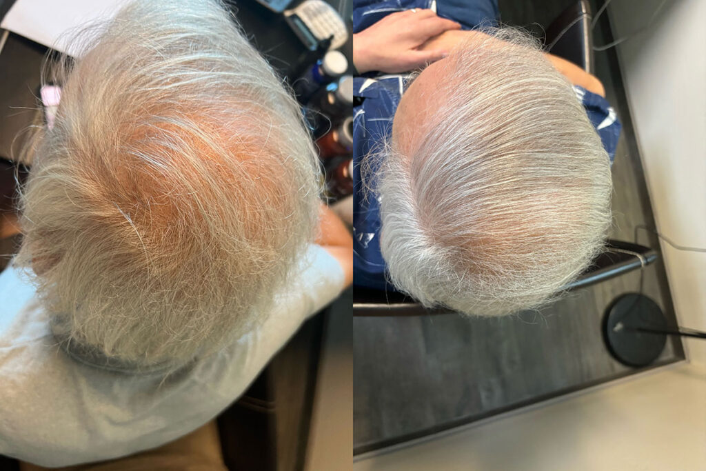 Regenicel Aesthetics Before & After