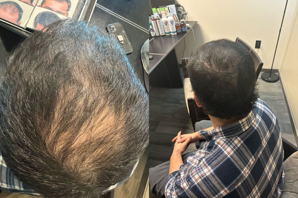Regenicel Aesthetics Before & After