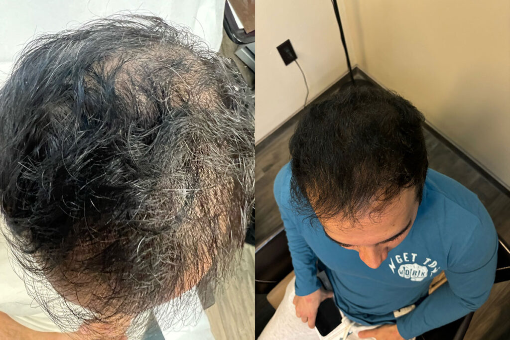Regenicel Aesthetics Before & After