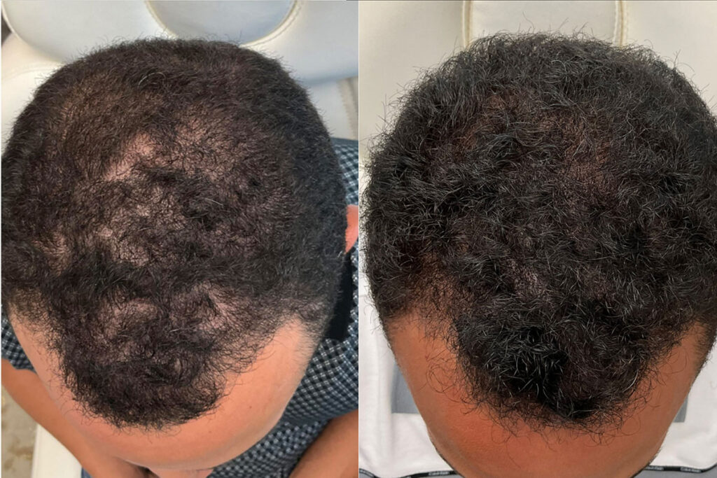 Regenicel Aesthetics Before & After