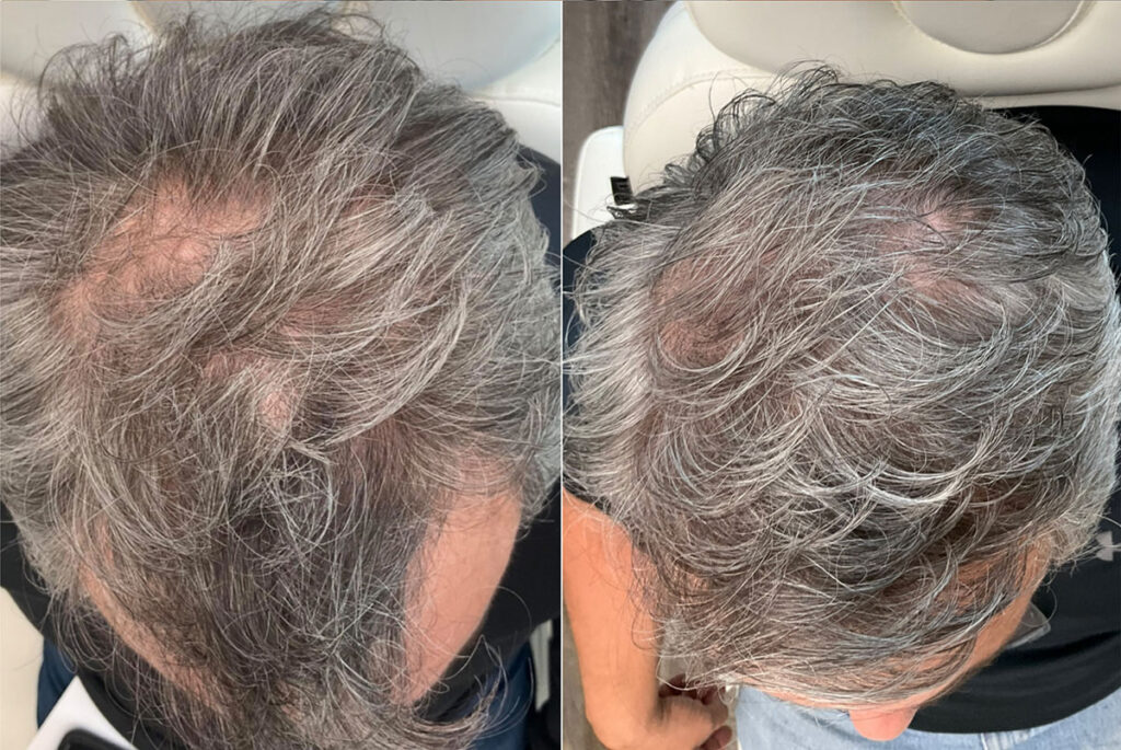 Regenicel Aesthetics Before & After