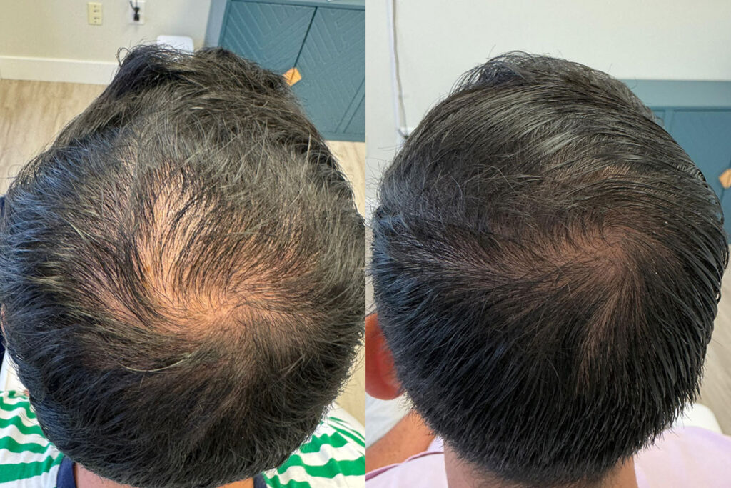 Regenicel Aesthetics Before & After