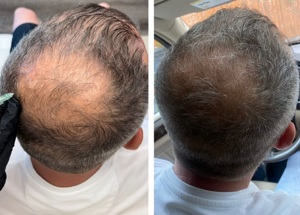 Regenicel Aesthetics Before & After