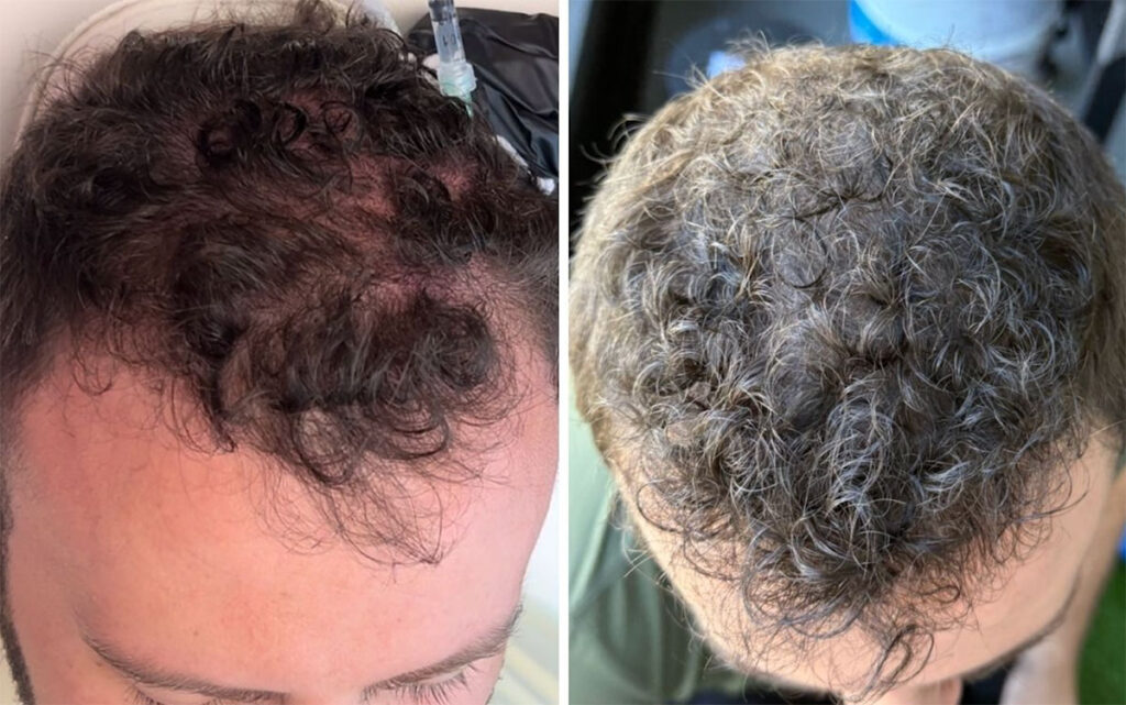Regenicel Aesthetics Before & After