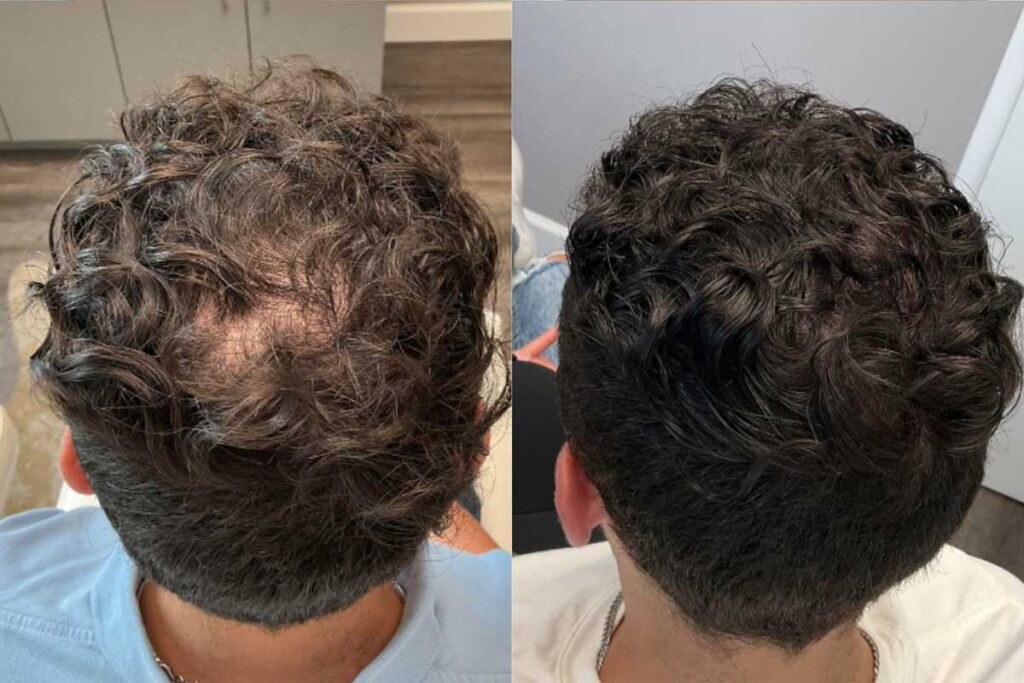 Regenicel Aesthetics Before & After